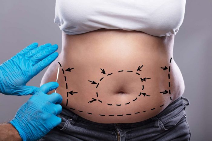 Does Insurance Cover Tummy Tuck